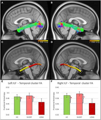 White Matter Abnormalities Associated With Prolonged Recovery in Adolescents Following Concussion